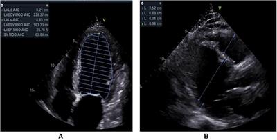 Single coronary artery presenting dilated cardiomyopathy and hyperlipidemia with the SCN5A and APOA5 gene mutation: A case report and review of the literature